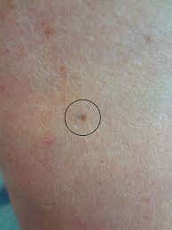Image result for Blue Nevus