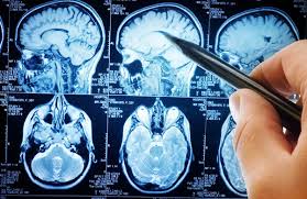 نتیجه تصویری برای MRI   سر