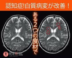 希望 認知症兆候 怖い白質病変が２つの食材で改善できた 健康技1 health health beauty health care