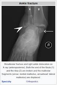 Medial ankle pain is pain on the inside of the ankle. Ankle Fracture Physiotherapy