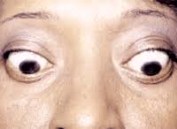 Lid lag is the static situation in which the upper eyelid is higher than normal with the globe in downgaze.1 it is most often a sign of thyroid eye disease, but may also. Normal Thyroid Abnormal Eyes