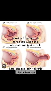 Image result for Uterine Inversion