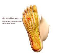 Morton S Neuroma Podiatrist Nyc Downtown Step Up Footcare