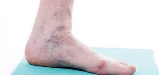 مطوي حلقة الوصل إعادة التأكيد ما هو مرض الدوالي عند الرجال dsvdedommel com