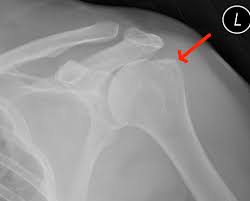 Image result for Shoulder History