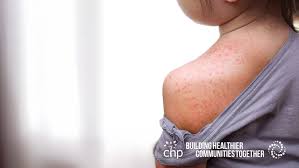 Image result for measles
