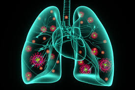 Image result for Pneumonia