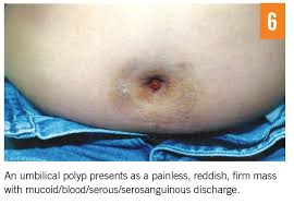 Image result for Umbilicus