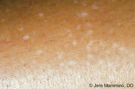 The spots occur due to the infection of the skin and in the process of tanning, the skin loses its pigment since the cells meant for producing melanin are blocked from doing so. Idiopathic Guttate Hypomelanosis American Osteopathic College Of Dermatology Aocd