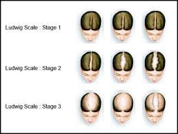 Hair loss may also be genetic. Female Hair Loss Treatment Providing Speedy And Effective Results