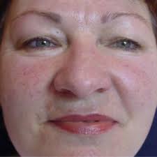 Rotungen Couperose Rosacea Kosmetische Behandlung Von Oberflachlichen Rotungen Singen Radolfzell Konstanz Bodensee