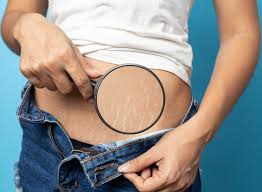 Stretch marks (striae) are indented streaks that appear on the abdomen, breasts, hips, buttocks or other places on the body. Stretch Marks Removal Williamsville Ny Smooth Solutions