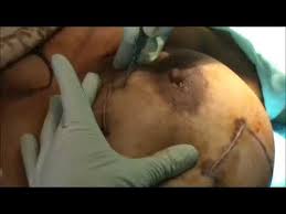 Also termed as reduction mammoplasty, this procedure requires the removal of excess breast tissue, glandular tissue and skin to attain the size, which is proportionate to your body. Breast Reduction In Elegance Clinic Surat Gujarat India By Dr Ashutosh Shah Youtube