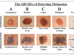 Skin cancer — the abnormal growth of skin cells — most often develops on skin exposed to the sun. Skin Cancer By Elli Seiff