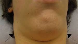Cancer or other serious lumps will have these signs: Lump Under Chin Causes Treatment And More