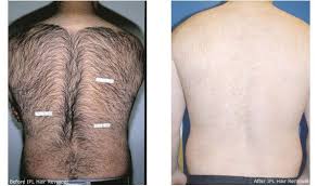 The only ipl with anintelligent sensoadapt™ skin tone sensor skin tone varies across your body, so the sensoadapt™ sensor (with uv protection) continuously reads the skin tone and adapts the flash intensity for the safest & most effective permanent visible hair removal. 36 Laser Hair Removal Quotes Ideas Laser Hair Removal Hair Removal Laser Hair
