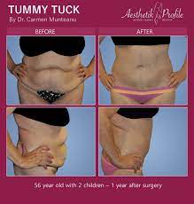 What is the symbolism of a fleur de lis? Fleur De Lis Abdominoplasty Melbourne Dr Carmen Munteanu