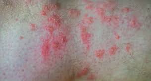 Image result for Fire Ant Sting