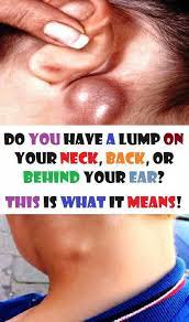 Do You Have A Lump In Your Neck Back Or Behind Your Ear This Really Is What It Means Dryskinlump Skin Bumps Lump Behind Ear Swollen Lymph Nodes