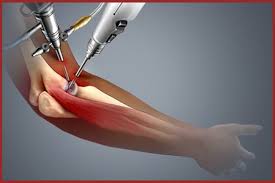 Image result for Elbow Joint Injection