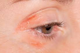 Face Psoriasis What To Do For Psoriasis Near Eyes