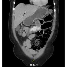 Image result for Adynamic Ileus