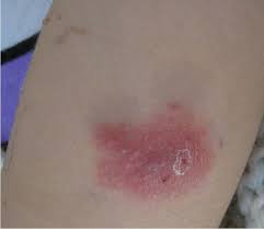 The illnesses resulting from aspergillosis infection usually affect the respiratory system, but their signs and severity vary greatly. Aspergillosis Dermatology Advisor
