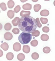 Not much is known about their formation, but they are thought to be remnants of the rough endoplasmic reticulum. Leukocytosis Cancer Therapy Advisor