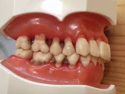 Nu trebuie exclus nici cancerul tiroidian. Dureri La Nivelul Coloanei Vertebrale Tuse Spondiloza Cervicala De Ce Apare Si Cum Se Trateaza