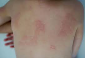 Image result for Papular urticaria