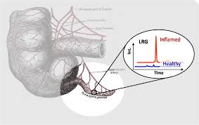 It is attached to the large intestine on the lower right side of the abdomen. A Urine Test For Appendicitis