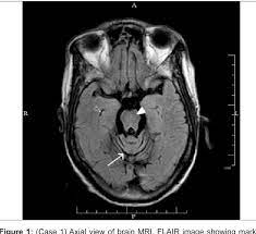 Pdf Ophthalmological Features Of Machado Joseph Disease Semantic Scholar