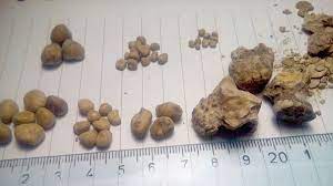 Batu karang di buah pinggang atau ureter akan menyebabkan halangan. Penyakit Batu Karang Punca Tanda Tanda Rawatan Dan Pencegahan
