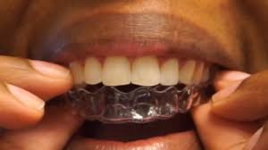 Why do i need a retainer? It S Here 2 Weeks Without A Retainer Before After Life After Braces Youtube