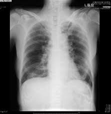 Therapeutic Potential Of Ciclesonide Inhalation For Covid 19 Pneumonia Report Of Three Cases Journal Of Infection And Chemotherapy
