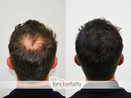 Cos'è la tricopigmentazione o micropigmentazione del cuoio capelluto. Tricopigmentazione Latina Milano Napoli Roma Pescara