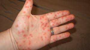 Image result for Hand foot and mouth disease HFMD roof of mouth
