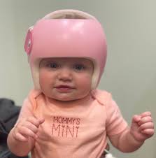 Cranial Helmets | Fالعلامات التحذيرية لخوذة علاج الرأس المسطح