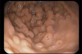 Image result for Gardner Sendromu