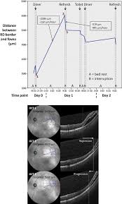 We did not find results for: Example Of The Change In Distance Between Retinal Detachment Rd Download Scientific Diagram