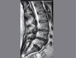 Στένωσις, contraído) es un término utilizado para denotar la constricción o estrechamiento de un orificio o conducto corporal. Mri Estenosis Pura L3 L4 Y L4 L5 Download Scientific Diagram