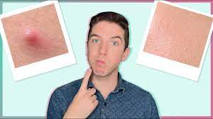 How I Get Rid Of A Pimple In One Day - Youtube