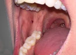 But in rare cases, it might. Does Your Mouth Look Like This Blood Blisters