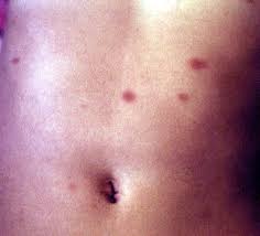 Image result for Urticaria pigmentosa children