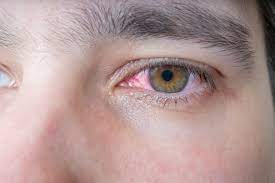 Die ursachen, die zu einer anämie führen, können unterschiedlich sein. Blut Im Auge Ursachen Symptome Und Therapie Heilpraxis