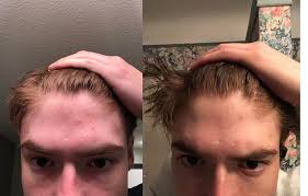 How long do the effects last? How Often To Use Ketoconazole Shampoo Reddit