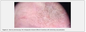 Vestibular Papillomatosis Mimicking Genital Warts In A Pregnant Woman/Gebe  Kadinda Genital Sigili Taklit Eden Vestibuler Papillomatozis. - Document -  Gale Academic Onefile