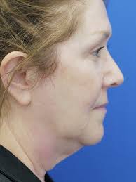 Deep Plane Face Lifting 2754