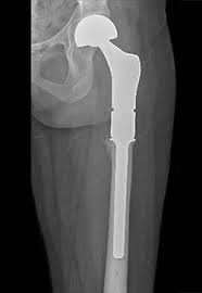 Image result for Chondrosarcoma