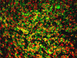 These early symptoms often include mood swings or emotional outbursts. Receptor Protein Prevents New Tumors In Mouse Model Of Glioblastoma Fiercebiotech